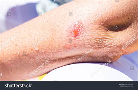 Poison Ivy Boil On Arm Stock Photo 1561222036 Shutterstock