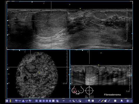 Whole Breast Ultrasounds Wbus Traf