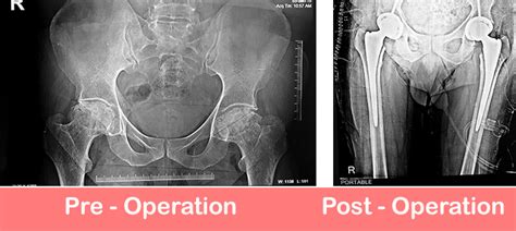 Bilateral Total Hip Replacement Dr Shekhar Agarwal
