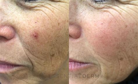 Pulsed Dye Laser Before And After Pictures Case 11 Natick Ma