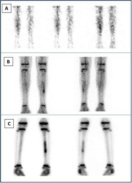 A Three Phase Bone Scan From The Legs Upper Row A Anterior Images