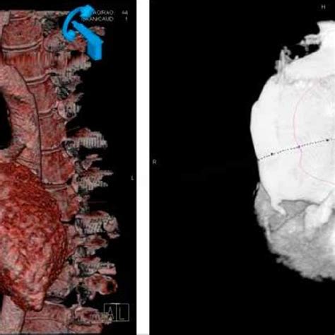 Computed Tomography Enlargement Of The Aortic Root 46 Mm Ascending