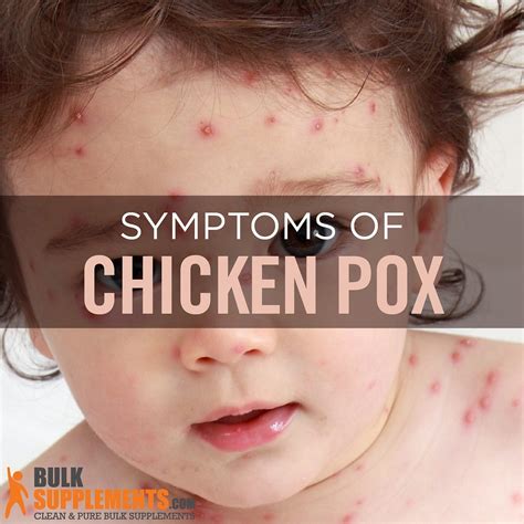 Varicella Chickenpox Causes Symptoms And Treatment By James
