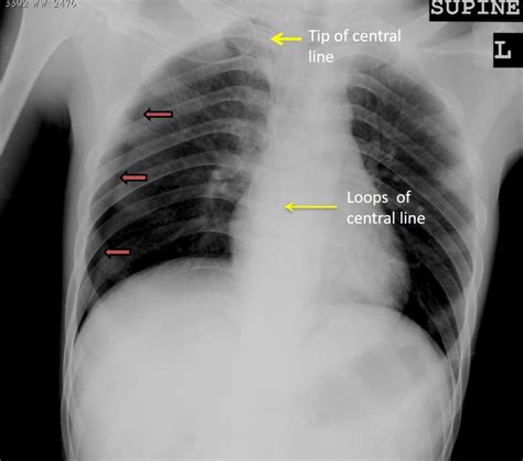 Iatrogenic Pneumothorax Radiology Cases