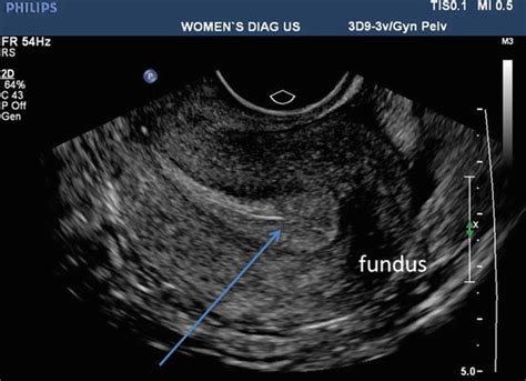 normal uterus transvaginal ultrasound