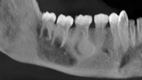 Mandibular Traumatic Peripheral Osteoma A Case Report Oral Surgery