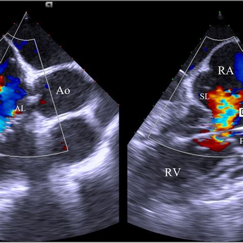 Mid Esophageal Right Ventricle Inflow Outflow View With Orthogonal