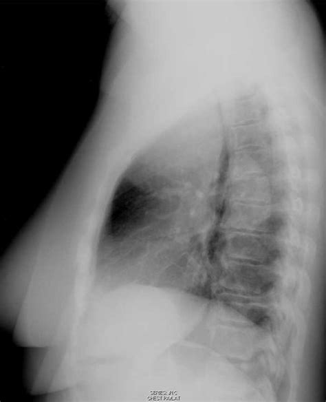 Thyroid Goiter On Chest X Ray X Rays Case Studies Ctisus Ct Scanning