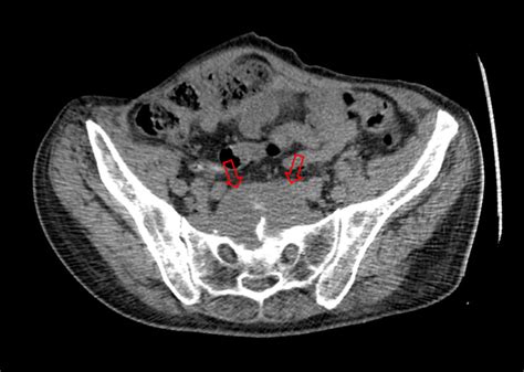Transverse Ct Image Showing Deep Pelvic Abscess Located At Presacral