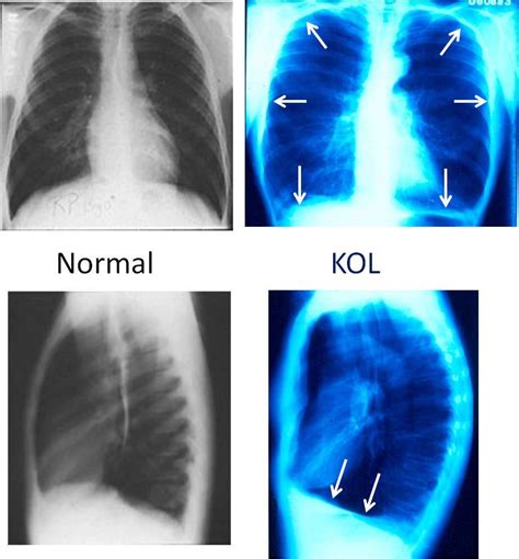 KOL lungröntgen jämförelse
