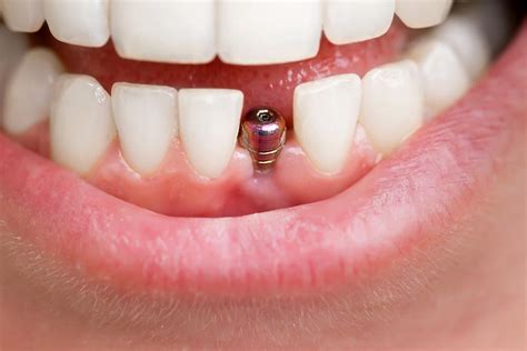 How Are Teeth Implants Done In One Day Teethwalls