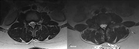 Mri Showing Enlargement Of Cauda Equina Roots On The Left A Normal