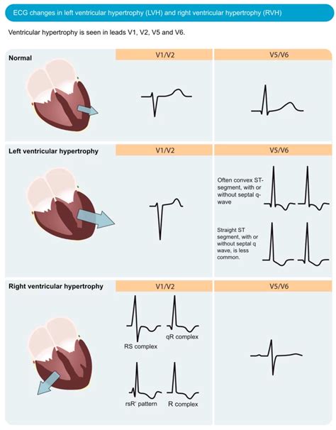 Ecg In Left Ventricular Hypertrophy Lvh Criteria And Implications