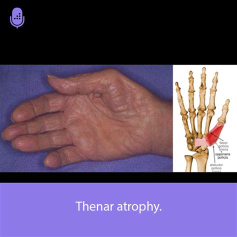 Orthobullets Thenar Atrophy On Hand Exam Is From Median Facebook