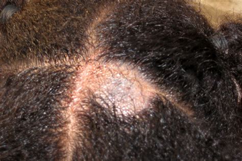 Tinea Capitis Often Overlooked In Adults Advances In Dermatology