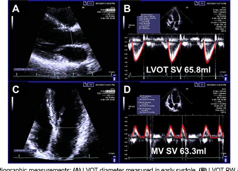 Echocardiography Transthoracic Real Time With Image Documentation 2d