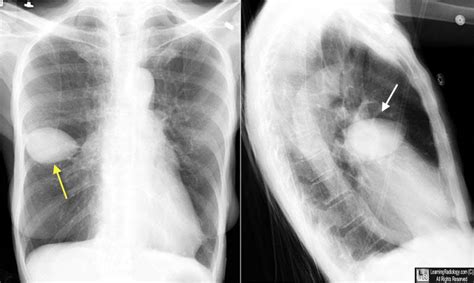 The pleural fluid may be classified as a transudate or an exudate, depending on ct is available for differentiation of pleural collections or masses, detection of loculated fluid collections, demonstration of abnormalities in lung. Learning Radiology - Pseudotumor, lung, vanishing, tumor
