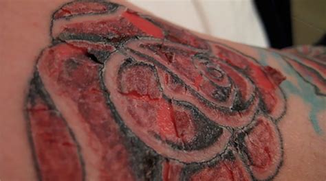 Infected Tattoo Stages Signs Of Infection From Tattoos And After