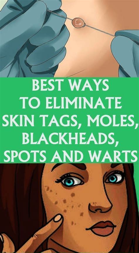 Best Ways To Eliminate Skin Tags Moles Blackheads Spots And Warts