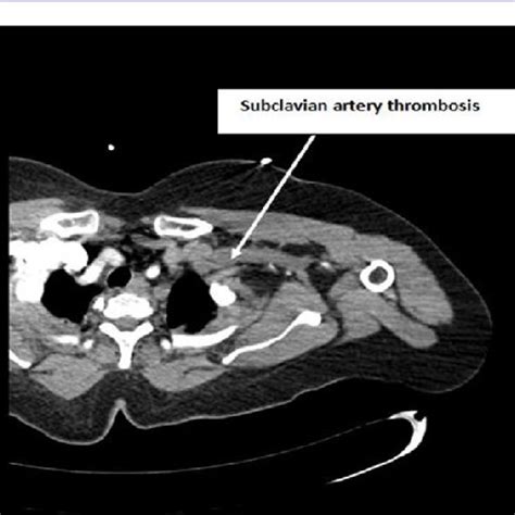Ct Angiogram Is Showing Subclavian Artery Thrombosis Figure 4 Ct