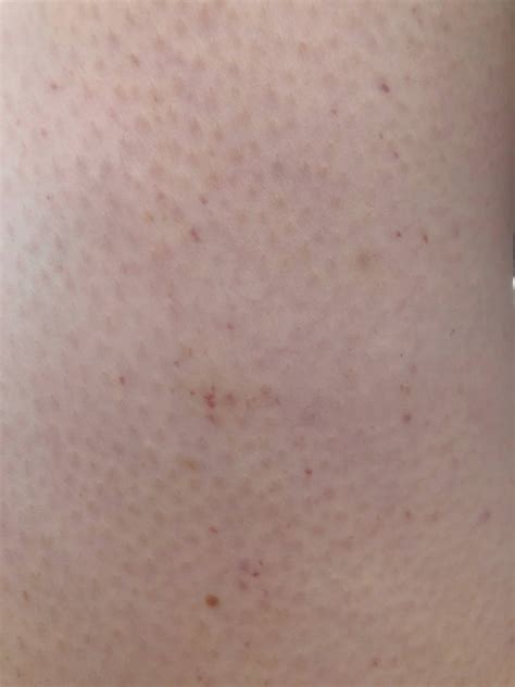 Petechiae Pinprick Red Dots On Skin Not Itchy Causes And Treatment Of