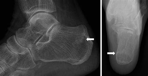 Calcaneus Fracture Axial View