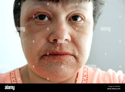 Woman Suffering With Eczema And A Rash Covering Most Of The Face With