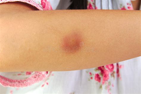 Bruise Or Hematoma On Wounded Girl Arm Stock Photo Image Of Contuse