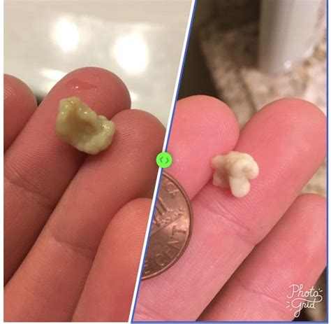 Some Of My Biggest Tonsil Stones Rmildlydisgusting