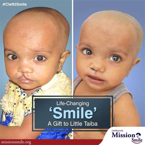 Mission Smile Provides Free Cleft Lip Care And Surgeries To Children