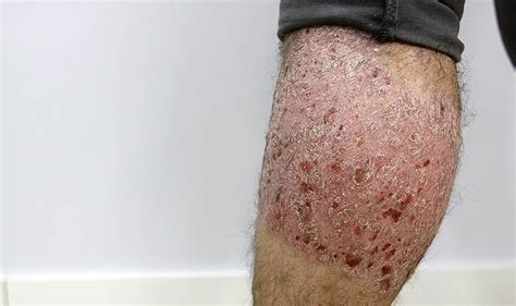 Dermatitis qué tipos hay y cómo se cura