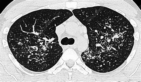 Pulmonary Sarcoidosis Ct Scan Stock Image C0212963 Science
