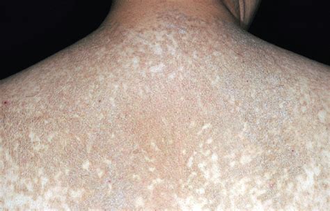 Is This Brown Scaly Rash Related To Obesity Consultant360