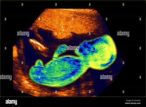5 Month Fetus Hi Res Stock Photography And Images Alamy