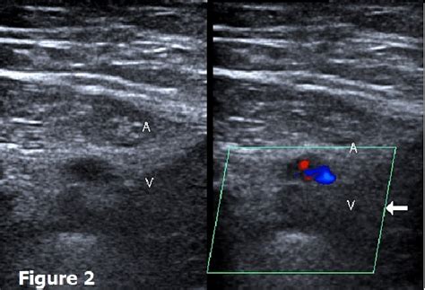 Doppler Ultrasound Of Lower Limb Arteries Ultrasound My Xxx Hot Girl