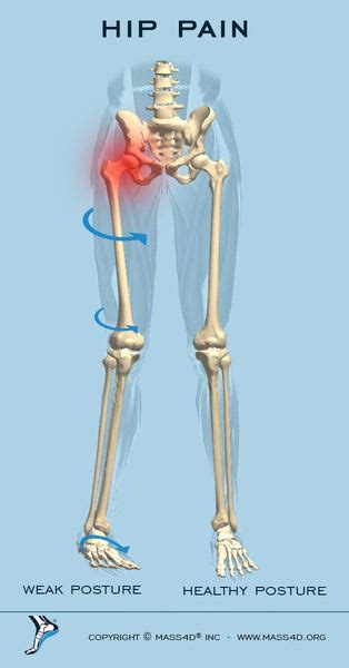 Can A Short Leg Cause Hip Pain Management