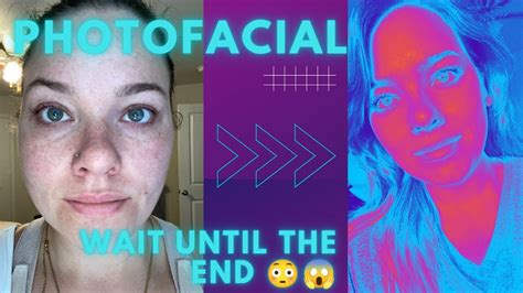 Ipl Photofacial Before During And After 30 Ish With Lots Of Sun