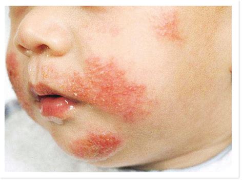 Common Baby Skin Problems Mother Baby And Kids