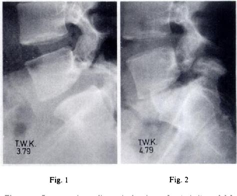 Figure 1 From Anterior Spinal Fusion For Spondylolysis And Isthmic