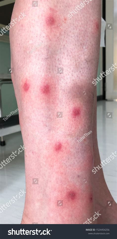 Multiple Illdefine Erythematous Itchy Papule Vesicles Foto Stok