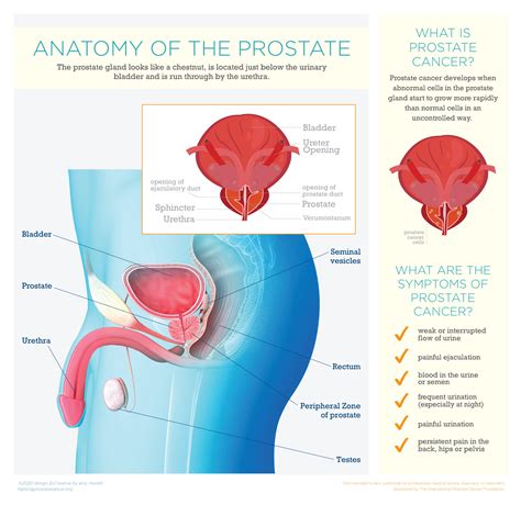 Downloads Guides International Prostate Cancer Foundation