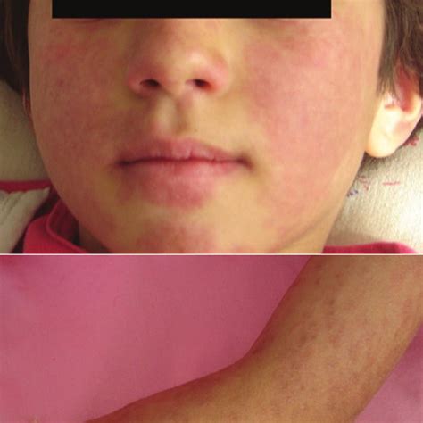 Generalized Erythematous Maculopapular Rash Of The Patient Download