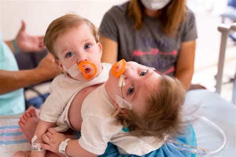‘power Of Positive Michigan Conjoined Twins Separated