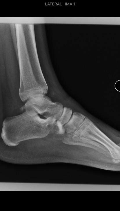 Cuboid Fracture The Foot And Ankle Online Journal
