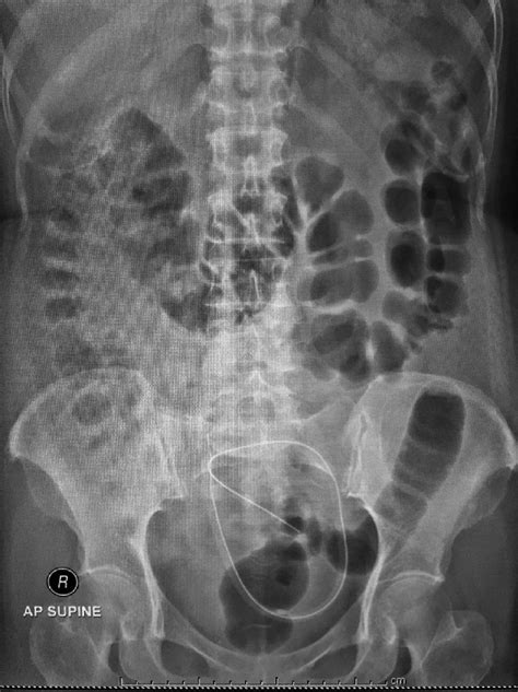 Plain Radiography Of The Abdomen In Case 1 Showing Acceptable Tenckhoff