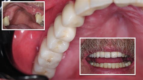 Reconstruction Of Upper Jaw Bone And Multiple Dental Implants For Fixed