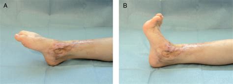 Extensive Loss Of Tibialis Anterior Tendon Surgical Repair With Split Tendon Transfer Of