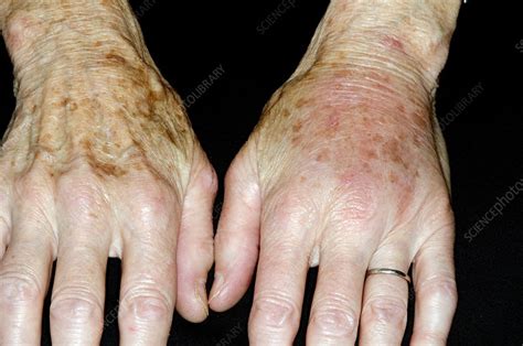 Swollen Hand After Insect Bite Stock Image C0167247 Science