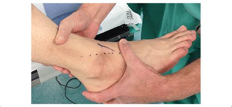 It was originally felt that it was positive when there was the foot must be stabilized by either sitting on it or placing ones hand, or an assistant's hand, against it. Image demonstrating the anterior drawer test (ADT) to ...
