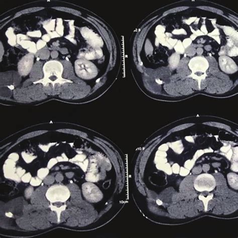 Contrast Enhanced Computed Tomography Ct Scan Showed A Large Cystic